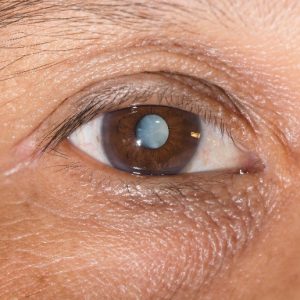 chicago bladeless cataract surgery