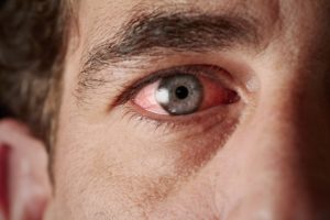 Dry eye treatment options