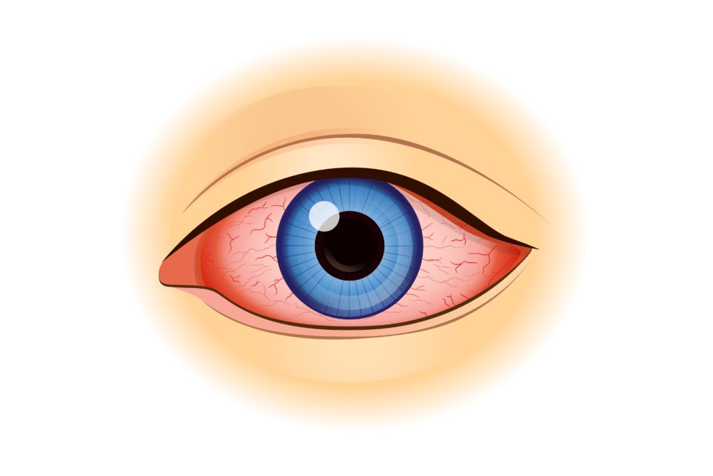 Swollen Eyelid Treatment Hoffman Estates, Palatine and Schaumburg