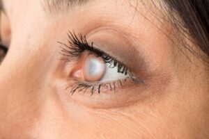 Cataract surgery in Hoffman Estates, IL