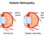 Diabetic retinopathy in Hoffman Estates, IL