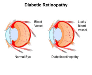 Diabetic retinopathy in Hoffman Estates, IL