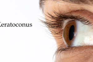 Keratoconus treatment Hoffman Estates